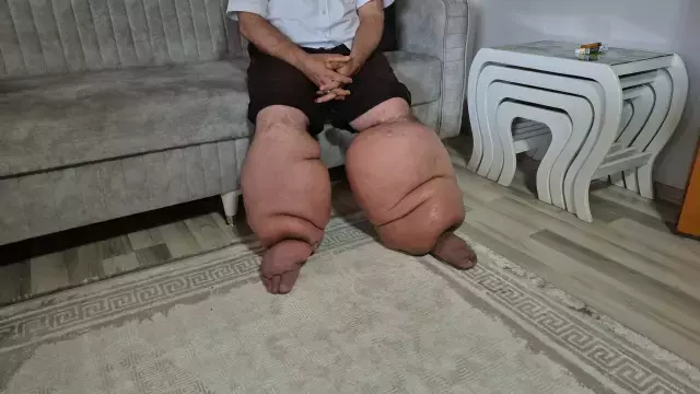 Fil Hastalığıyla Mücadele Eden Seyfettin Taşcı'nın Yardım Çağrısı