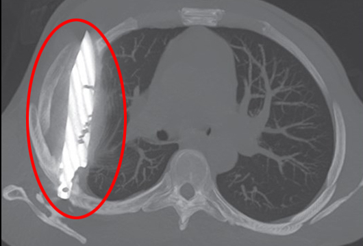 Göğüs ağrısıyla hastaneye gitti, göğsünde 8 yıldır bıçakla yaşadığı ortaya çıktı!