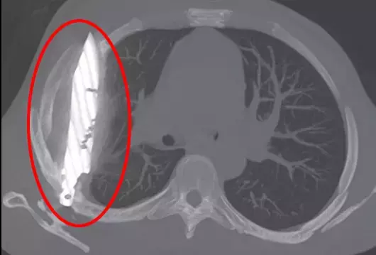 Göğüs ağrısıyla hastaneye gitti, göğsünde 8 yıldır bıçakla yaşadığı ortaya çıktı!