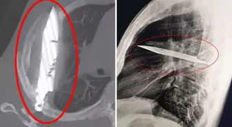 Göğüs ağrısıyla hastaneye gitti, göğsünde 8 yıldır bıçakla yaşadığı ortaya çıktı!